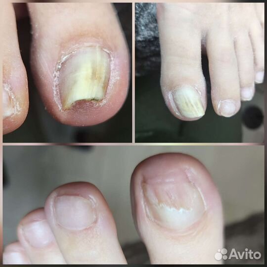 Лечебный педикюр подолог