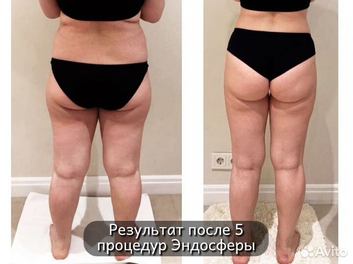 Модели на антицеллюлитный массаж (эндосфера)