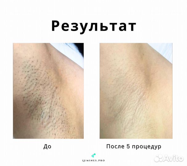 Аппарат для эпиляции люминес Max One 1200вт