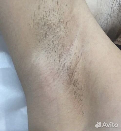 Электроэпиляция Apilus