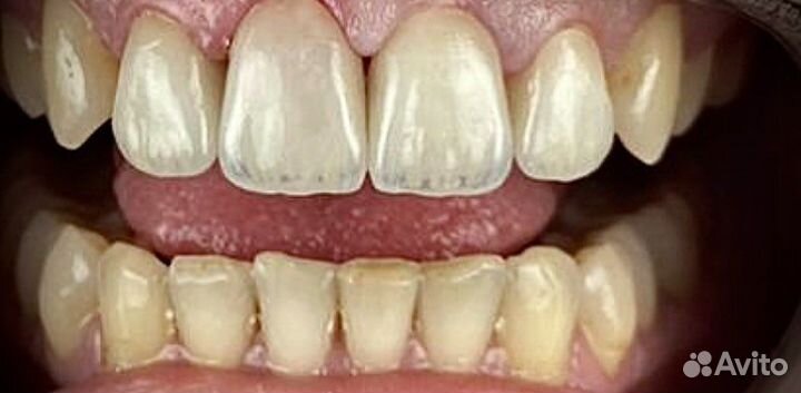 Изготовление эстетических коронок