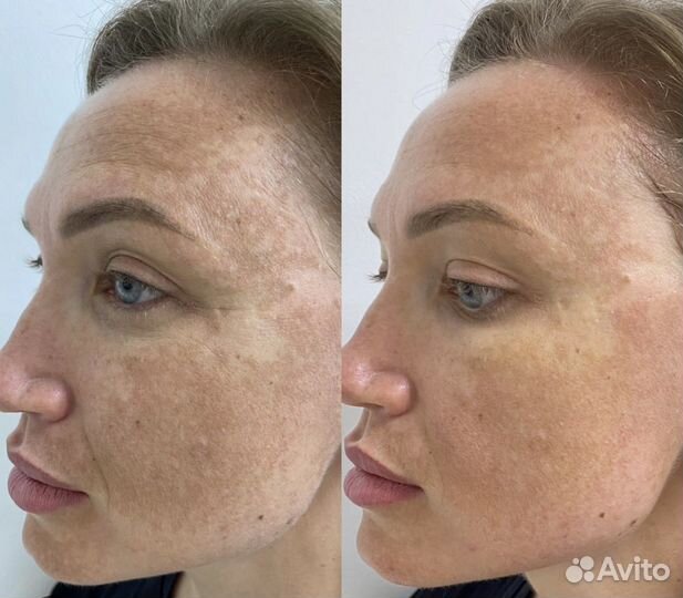 Микроигольчатый RF лифтинг косметолог омоложение