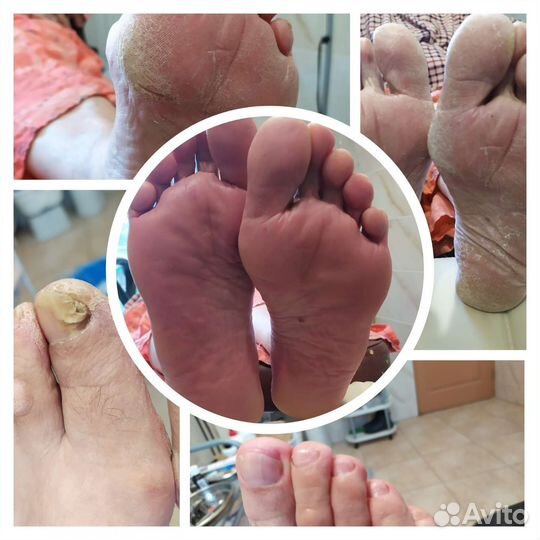 Педикюр сложных стоп. Услуги Подолога