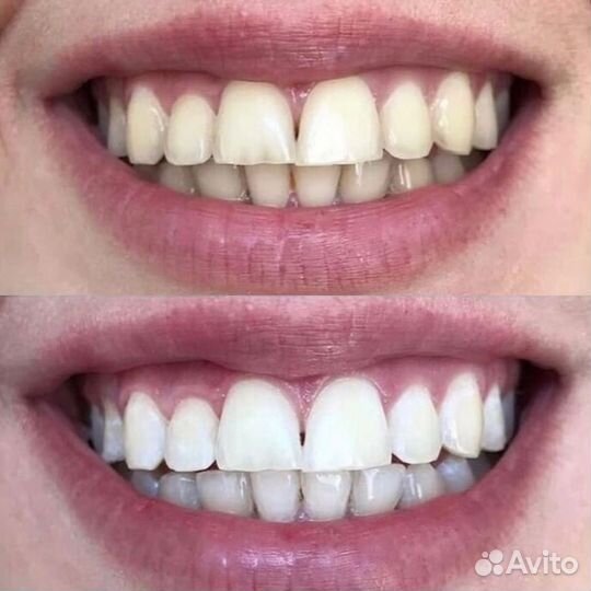 Отбеливание зубов