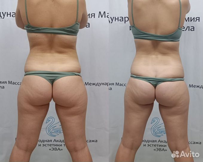 Липомоделирующего SPA - релакс массажа; кинезиотей