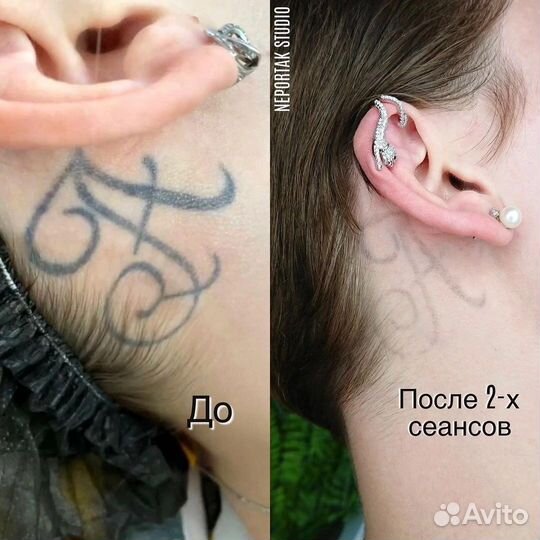 Удаление татуировок