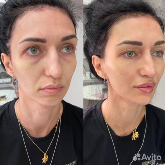 Королевский лифтинг 