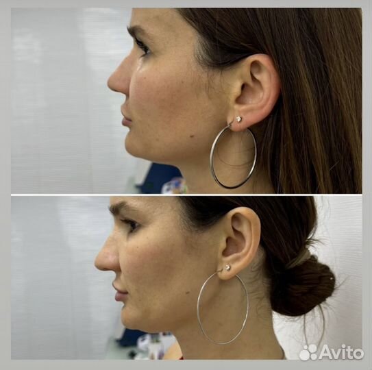 Косметолог худое лицо липолитики