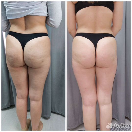 Аппаратный массаж