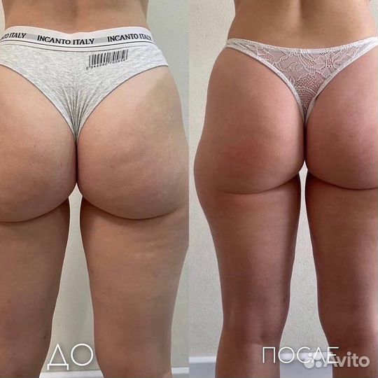 Антицеллюлитный массаж