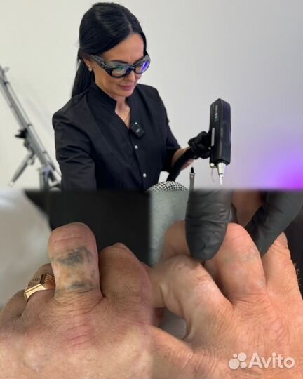 Лазерное удаление тату, ПМ, карбоновый пилинг