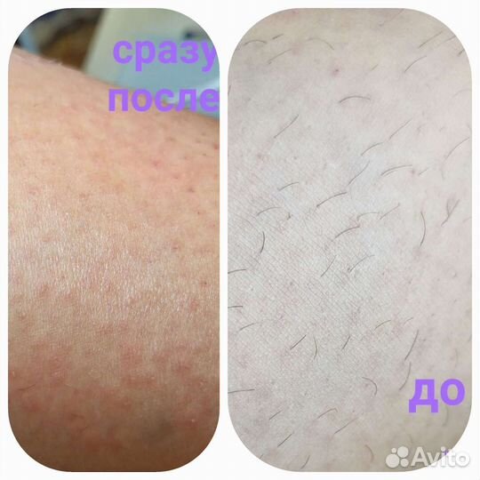 Электроэпиляция