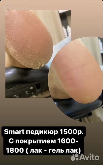 Педикюр smart