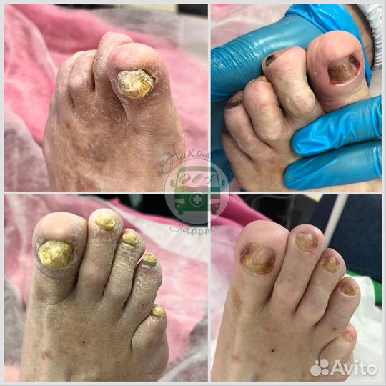 Подолог,медицинский педикюр,педикюр пожилым. Выезд