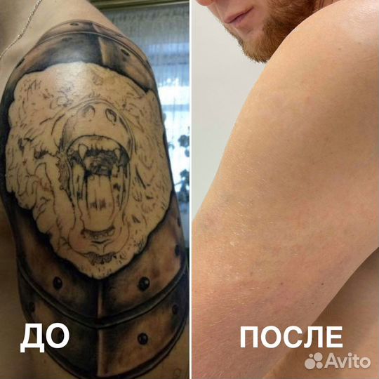 Удаление тату и татуажа в клинике Sokolov Laser