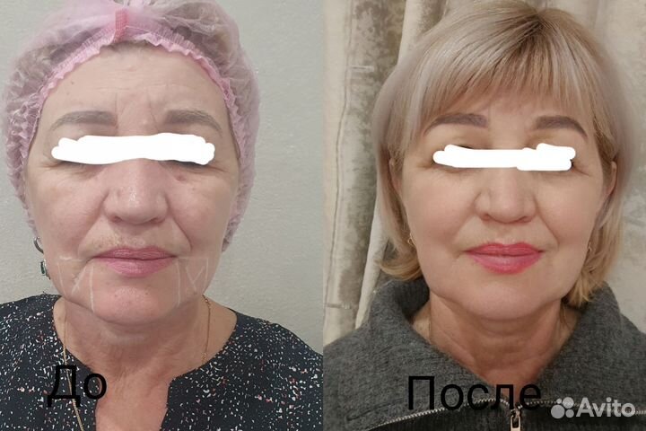 Аппаратная косметология