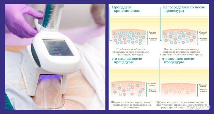 Криолиполиз, смас-липосакция