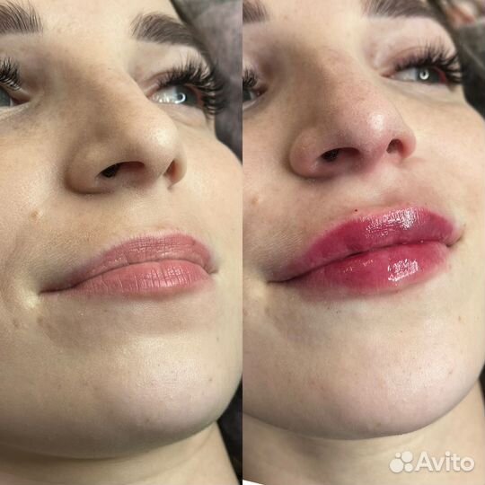 Косметолог:увеличение губ,ботокс,чистка,full face