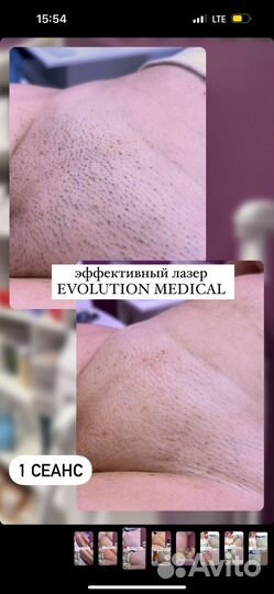 Лазерная эпиляция