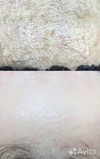 Биоревитализация