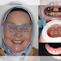 Имплантация зубов all on 4 (все на 4), Москва