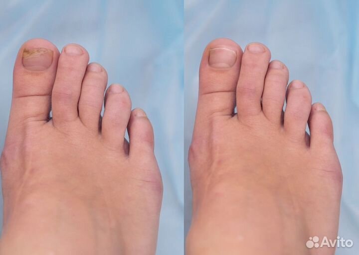 Средство от грибка ногтей широкого действия