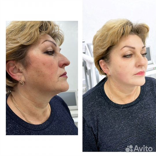 Аппаратная мезотерапия