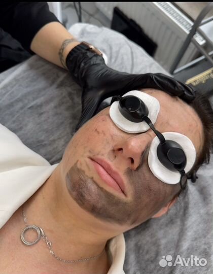 Карбоновый пилинг