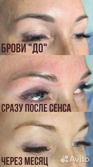 Удаление татуажа