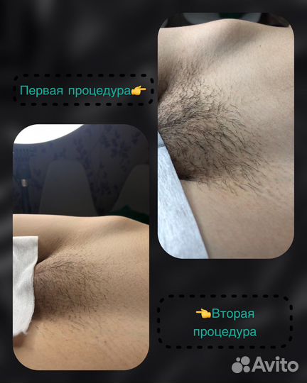 Шугаринг/Воск депиляция