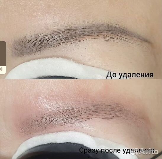 Удаление татуажа лазером