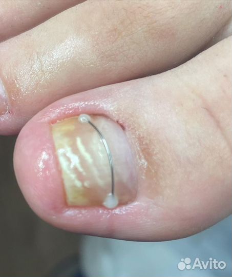 Педикюр лечебный - подолог