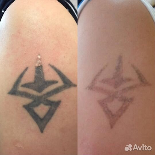 Удаления татуировок и татуажа