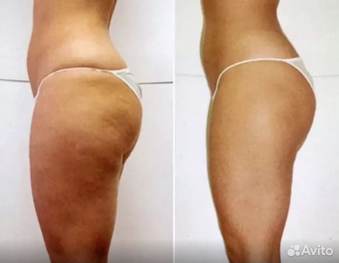 Массаж LPG Integral (франция) тело и лицо