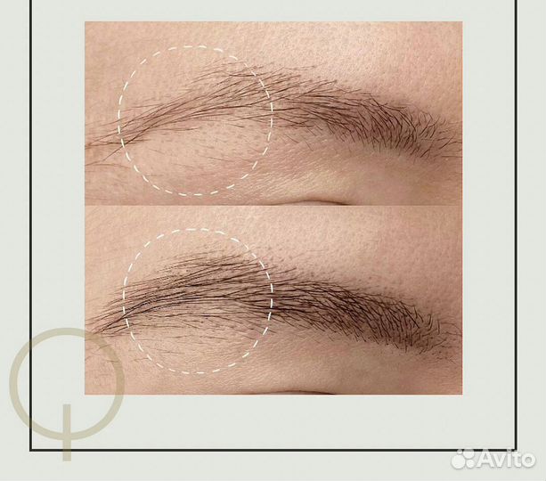 Восстановление роста волос бровей за 4 процедуры