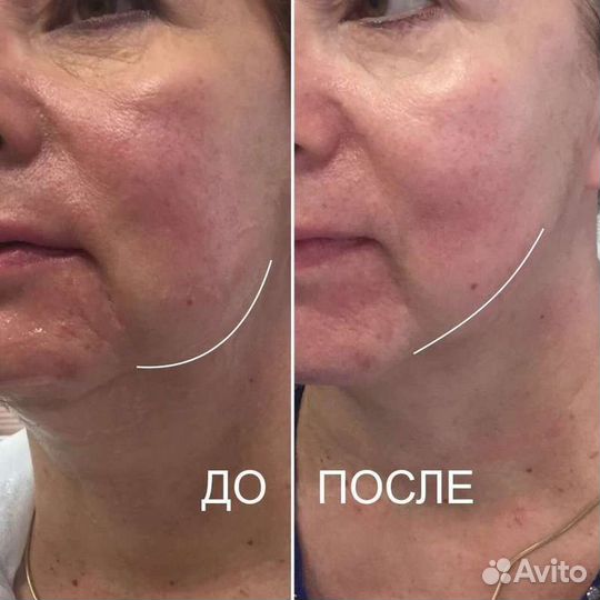 Скульптурный массаж лица