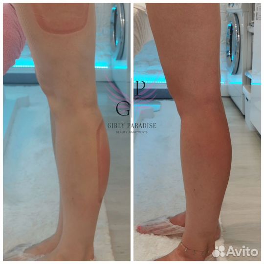 Криолиполиз