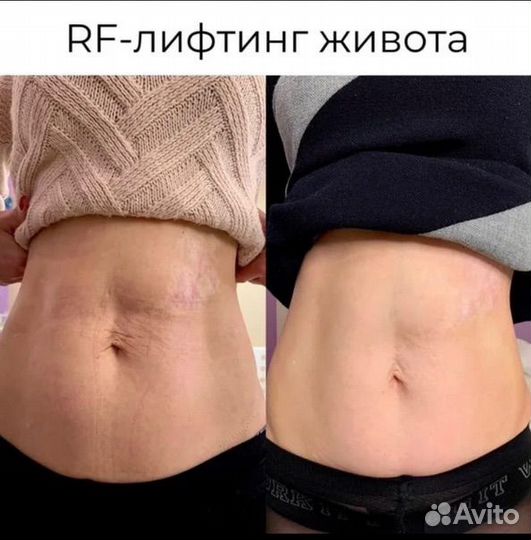 Микроигольчатый RF лифтинг