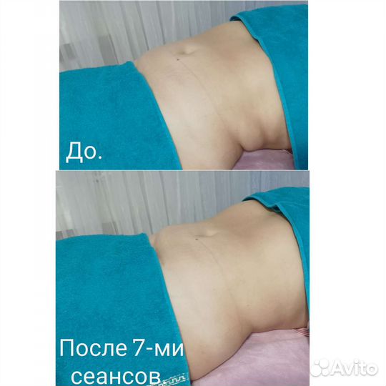 Вакуумно-роликовый массаж