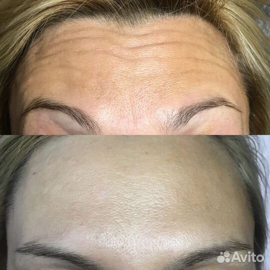 Ботокс для лица