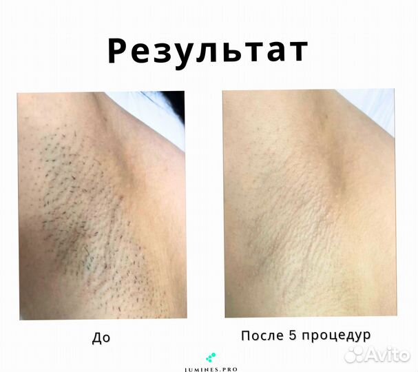 Диодный лазер Люминес Max One 1200в