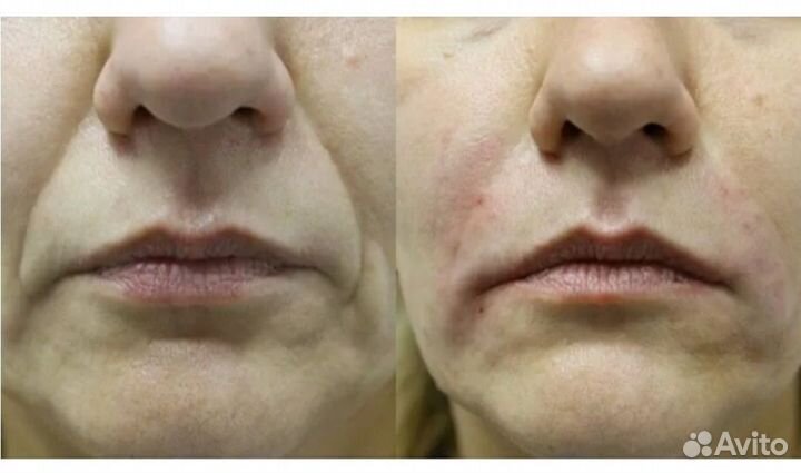 Услуги косметолога уколы красоты