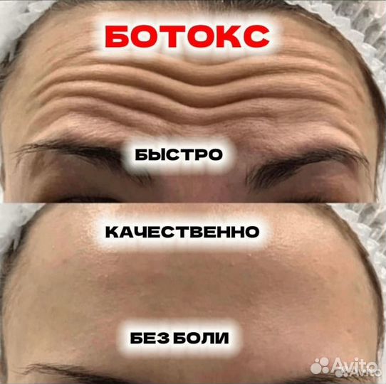 Ботокс для лица
