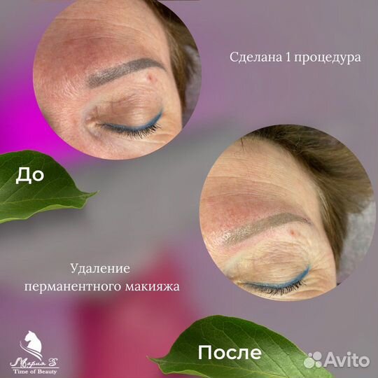 Удаление тату и Перманента