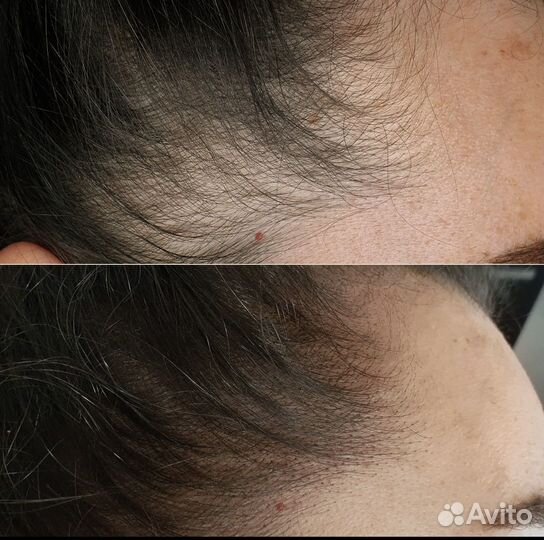 Трихопигментация