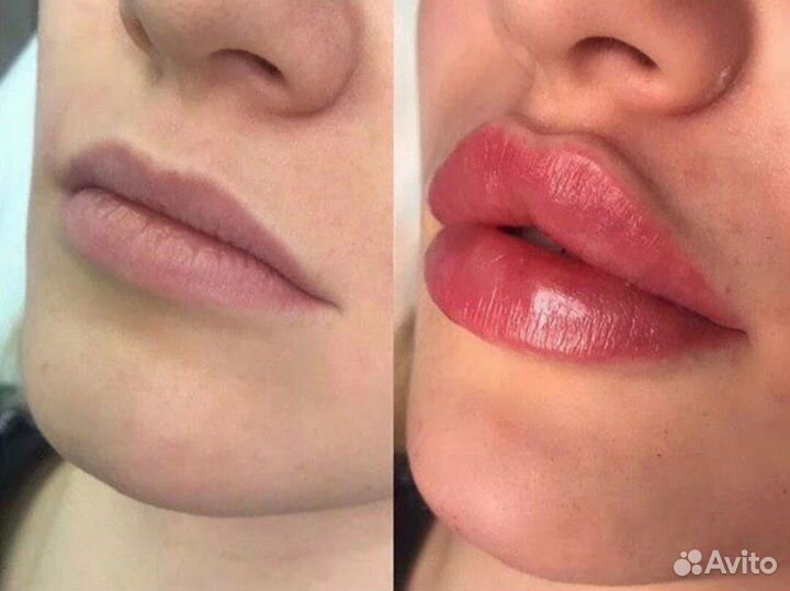 Модель на увеличение губ