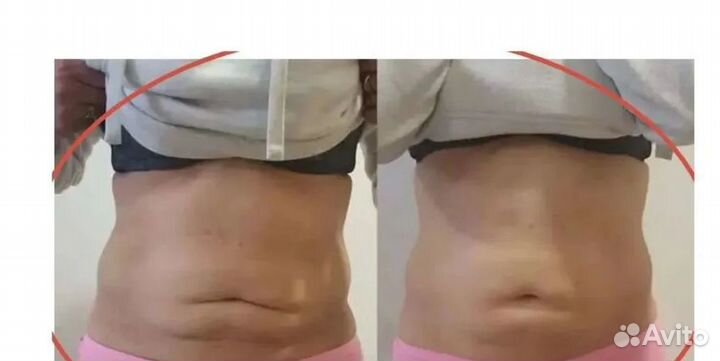 Похудение для мужчин и женщин Криолиполиз Кирове