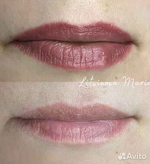 Удаление татуажа