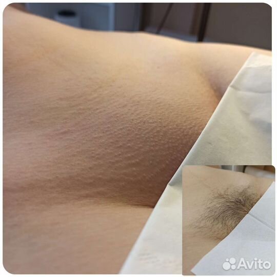 Шугаринг и ваксинг