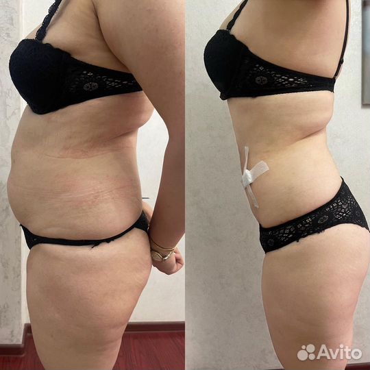 Лазерная липосакция